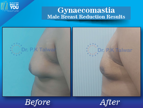 Gynaecomastia before after image